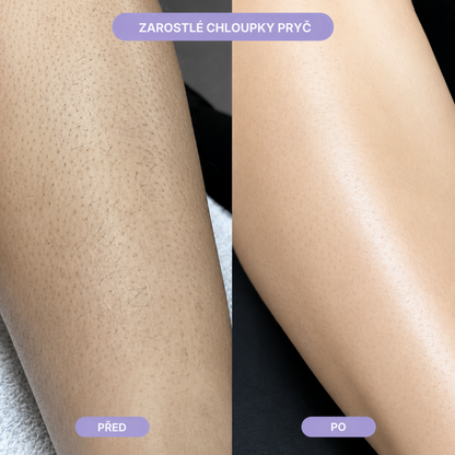 Skinora – nano skleněný odstraňovač chloupků