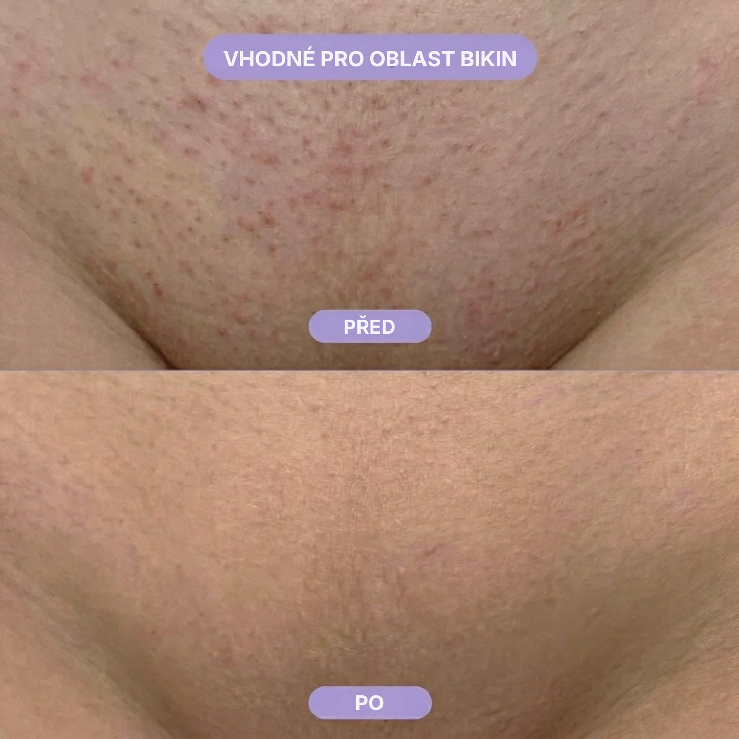 Skinora – nano skleněný odstraňovač chloupků