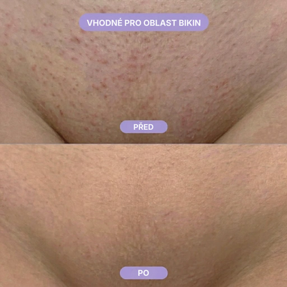 Skinora – nano skleněný odstraňovač chloupků
